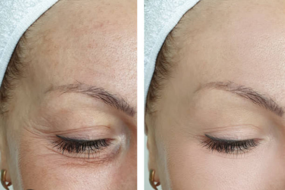 Anti-Aging
